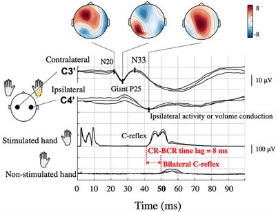 Bilateral Representation of Sensorimotor Responses in Benign Adult Familial Myoclonus Epilepsy: An MEG Study